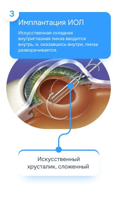Имплантация ИОЛ
