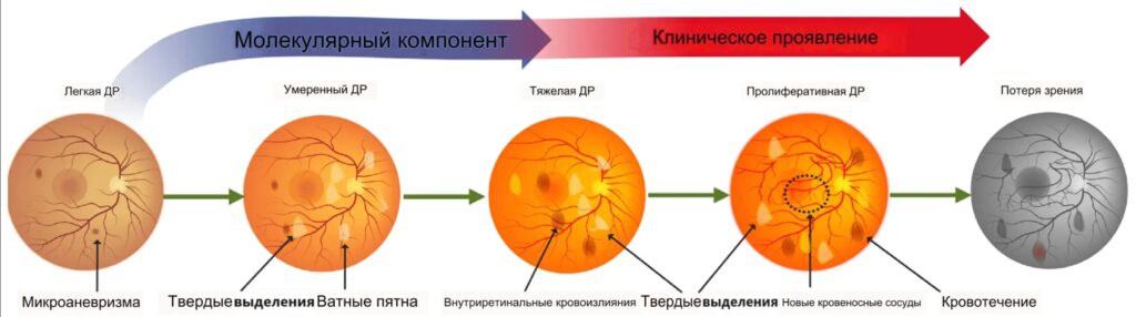 Стадии поражения сетчатки при диабете.