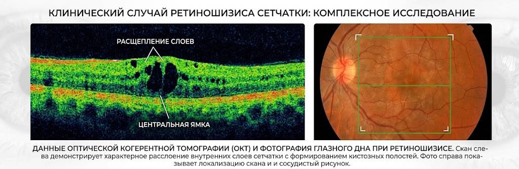 Ретиношизис сетчатки: причинно-следственные связи, формы и современный подход к лечению